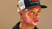 Firefighter burned in deadly Washington fire leaves hospital