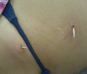 A catfish embedded itself into a woman's stomach in Brazil.