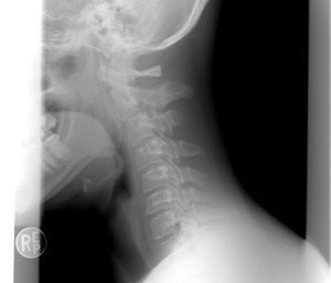The spinal cord can be injured by a variety of mechanisms.