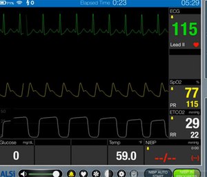Cardiac monitoring flashing indicators of abnormal SpO2 and ETCO2.