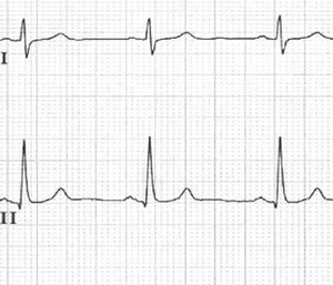 While there are some advantages to obtaining a 12-lead ECG, there are also some limitations.