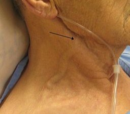 A person with congestive heart failure who presented with an exceedingly elevated jugular venous distension – the arrow is pointing to the external jugular vein, however, JVD is measured by the internal jugular vein which can also be seen here