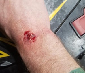 A paramedic who was bitten by a patient is currently off the job recovering from the incident. (Photo/Detroit Fire Fighters Association)