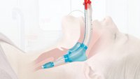 Study: Laryngeal tubes could increase cardiac arrest survival