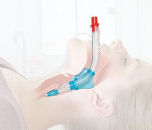 A study has shown that a change in the type of breathing tube paramedics use to resuscitate patients with sudden cardiac arrest can improve the odds of survival.