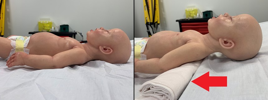 Try a rolled-up towel under the shoulders to help manage the pediatric airway.