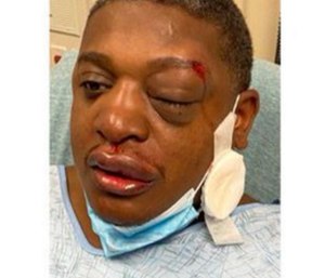 The officer was left with several contusions and bruising to his face and head. (Photo courtesy of New Jersey State Policeman's Benevolent Association)