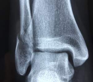 Percuss a bony prominence at one end of a long bone while auscultating over the other end.