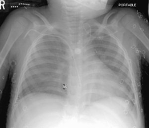 Early intubation is important, but not at the expense of causing your patient to code.