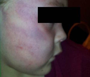 Bruising consistent with abuse.