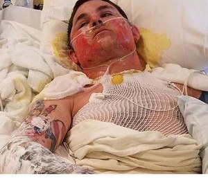 Damon Spring (pictured) and Bart Negro remain hospitalized after suffering severe burns while battling the Sheep Creek fire. (Photo/GoFundMe)