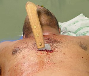 Removal of the knife is an absolute last resort, as it likely could contribute to further exsanguinating hemorrhage.