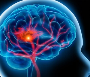 Stroke is one of the high-risk time-sensitive conditions that benefits from a systems of care approach.