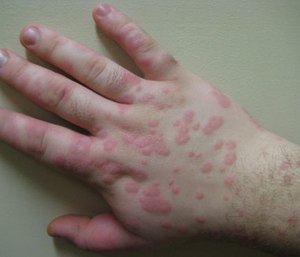Valley fever is a fungal infection that can cause chest pains, coughing and bumps and rashes on the skin. (Photo/Wikimedia Commons)