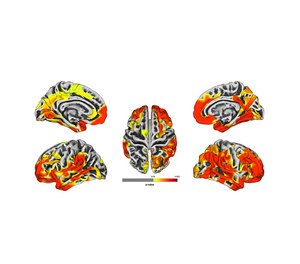 These brain images are a compilation of MRI results from 9/11 responders. The images show gray matter atrophy on the brain, with yellow and red areas revealing statistically significant atrophy compared to the normal population. Red areas show worse atrophy than yellow.