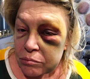 This Oct. 15, 2017, photo provided by the subject shows Pandora Lobacz, a teacher in Wisconsin's juvenile corrections system, who was injured in an Oct. 11 attack by a young inmate at the state's Lincoln Hills School in Irma, Wis. (Courtesy of Pandora Lobacz via AP)