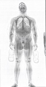 Click here for a full-sized version.The Caddo Parish Sheriff's Office released this image of the body scan they say shows the contraband cell phone inside Anthony Alvey's body