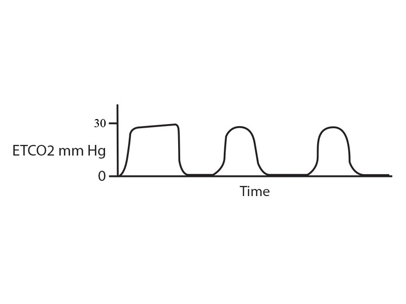 4 Things Paramedics Need To Know About Capnography And Heart Failure