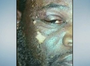The assaulted officer is shown here with chemical burns to his face. (Photo Times Warner)