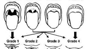 Airway Class Vs Airway Grade Know The Distinction