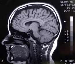 Magnetic Resonance Imaging of a human head is displayed with an exhibit on the history of imaging of the brain at the Museum of Neuroanatomy at the University at Buffalo, in Buffalo, N.Y. Sometimes the brain works against firefighter safety, according to fire service educator Richard Gasaway, speaking at FRI 2013.