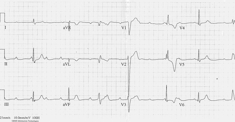 12 Lead Ekg Anterior Infarct 7546