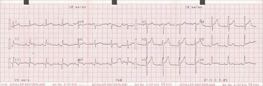 Inferior STEMI. There is > 1mm of ST elevation in leads II, III and