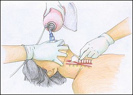 A medical illustration of applying pressure to the cricoid cartilage
