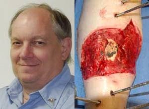 Photo courtesy American Ambulance AssociationJohn Kelly's leg after the accident was so badly injured, doctors recommended he amputate. He stubbornly refused and is now walking.