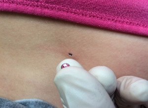 Removing microdermal implants: A photographic tutorial Removing microdermal implants: A photographic tutorial