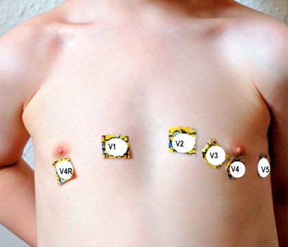 pediatric ecg electrode placement