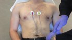 A simplified method for 12-lead ECG electrode placement