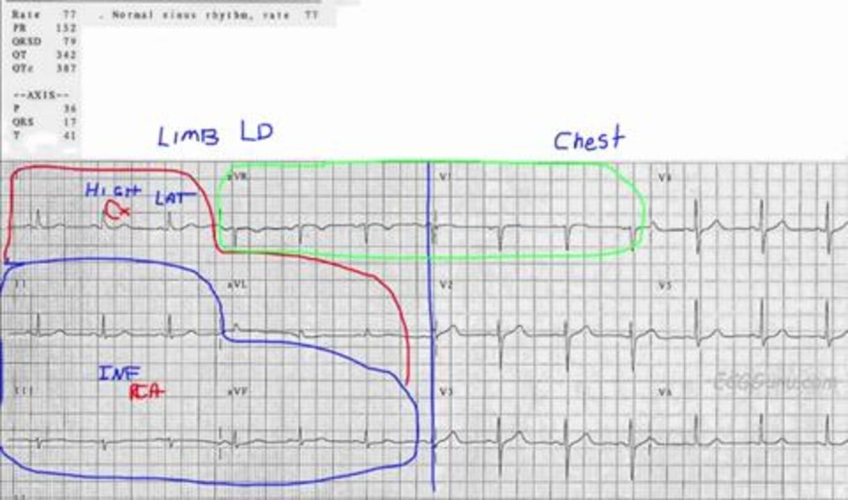 Video: How to map an ECG