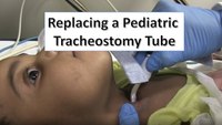 Replacing a pediatric tracheostomy tube