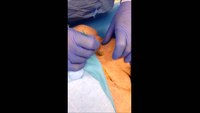 SloMo surgical cricothyrotomy performed in 5 steps