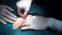 DermaClip: Closure of 3 a inch surgical incision