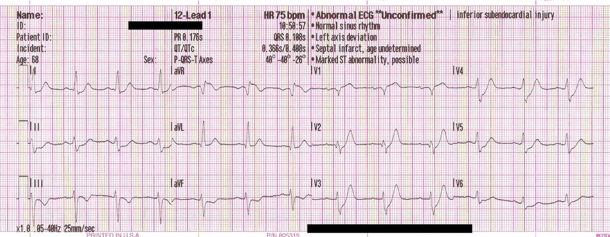 ivcd with st elevation