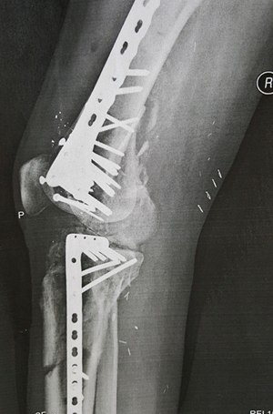 X-ray of his leg.