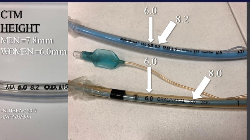 Drew, Khan, and McCaul (2019) discovered the insertion of an i-gel supraglottic airway device assisted in the 66% accuracy of locating the CTM in female patients [5].