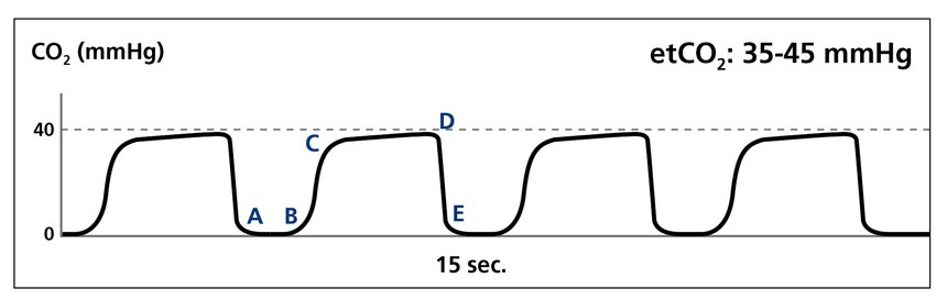 COVID patients don’t necessarily present with a specific waveform like the “shark fin” for bronchospasm. You may see the “normal” pattern represented by this reading, or another pattern that indicates respiratory distress. (image/Medtronic)