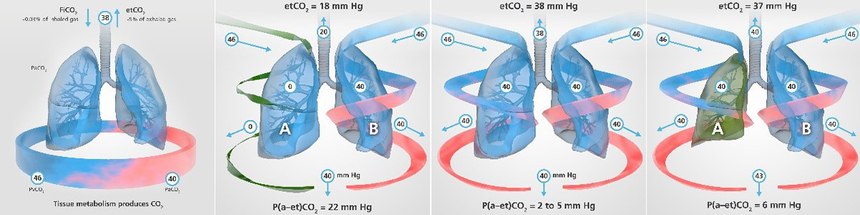 Simply saying that the patient’s EtCO2 value is “29” or “52” doesn’t really tell us anything. Using capnography helps to put value into your patient’s clinical context.