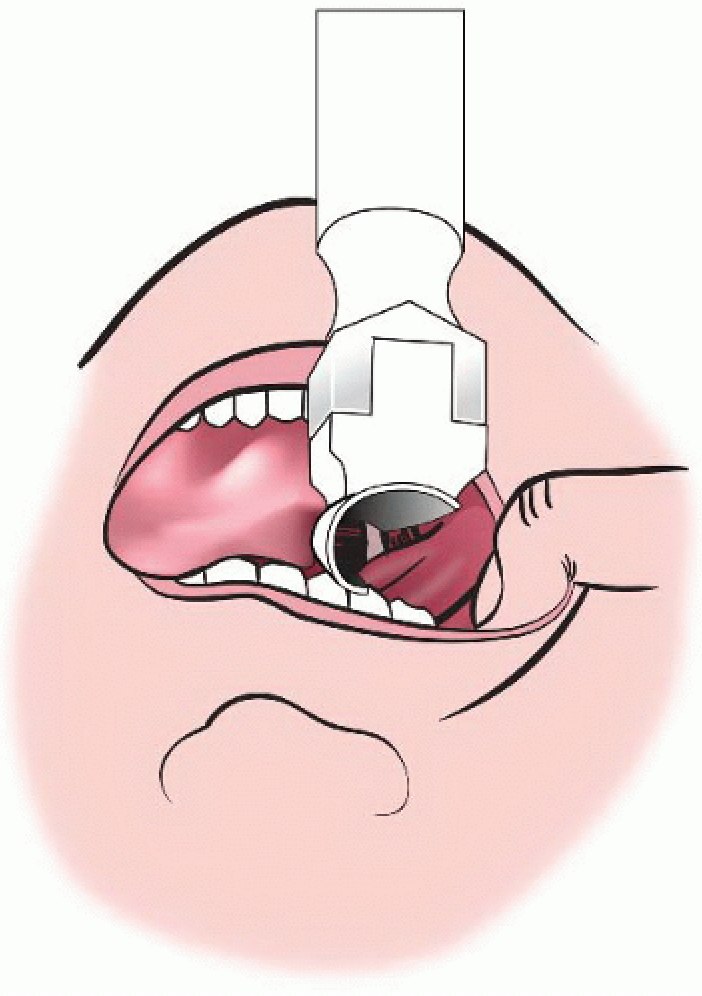 (Figure 2/Courtesy https://aneskey.com/direct-laryngoscopy-2/)